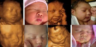 Are There Any 3D Ultrasound Risks to Be Aware Of?